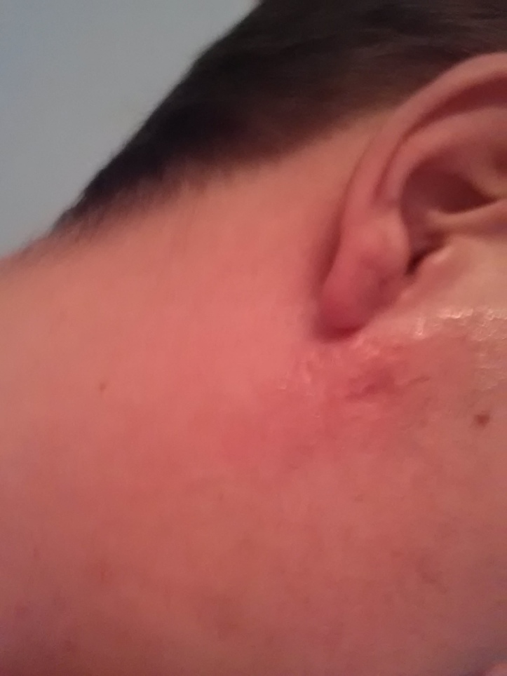 1 Month after my Black Salve Treatment on a Cancerous Mole on my face.