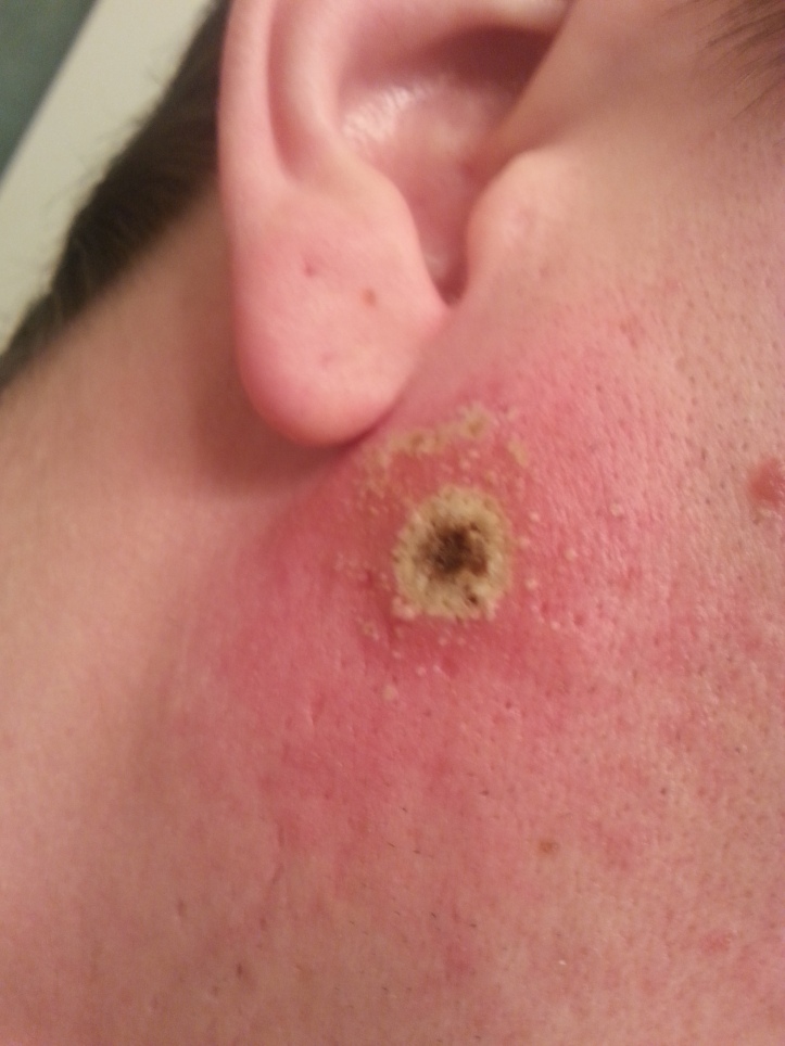 Day 2 of my Black Salve Treatment on a Cancerous Mole on my face.