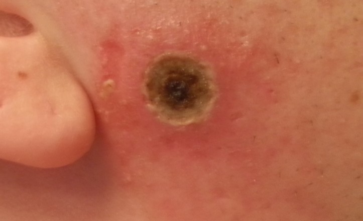 Day 3 of my Black Salve Treatment on a Cancerous Mole on my face.