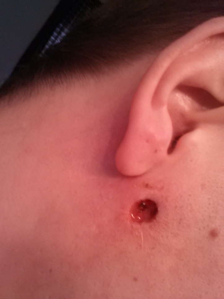 Day 4 of my Black Salve Treatment on a Cancerous Mole on my face.